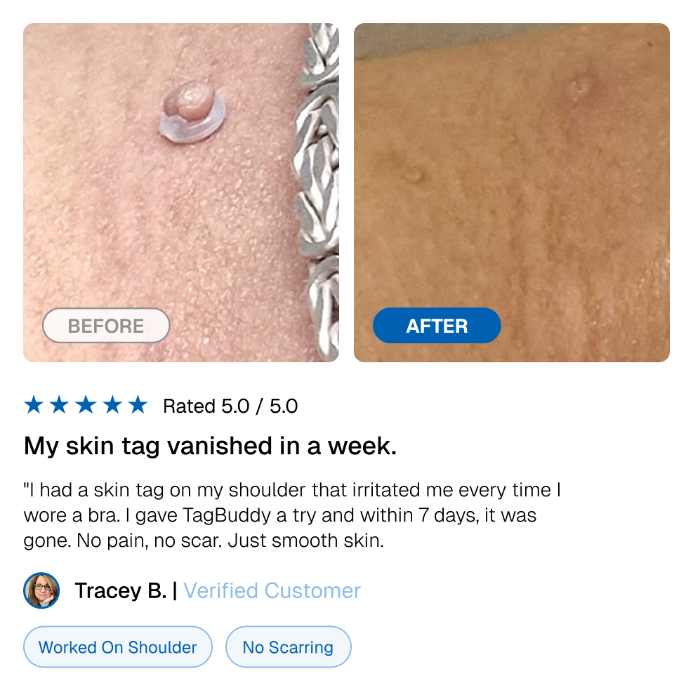 TagBuddy Kit – No More Skin Tags
