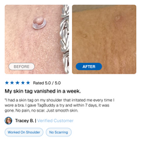 TagBuddy Kit – No More Skin Tags