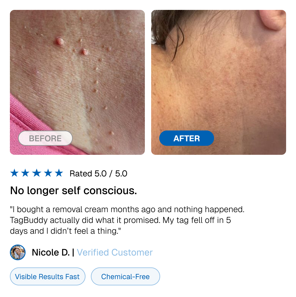TagBuddy Kit – No More Skin Tags