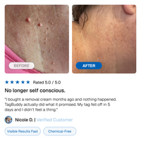 TagBuddy Kit – No More Skin Tags