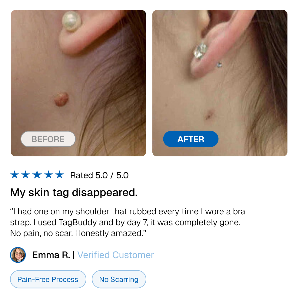 TagBuddy Kit – No More Skin Tags