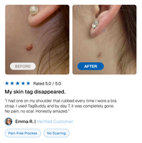 TagBuddy Kit – No More Skin Tags