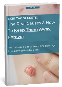 TagBuddy Kit – No More Skin Tags